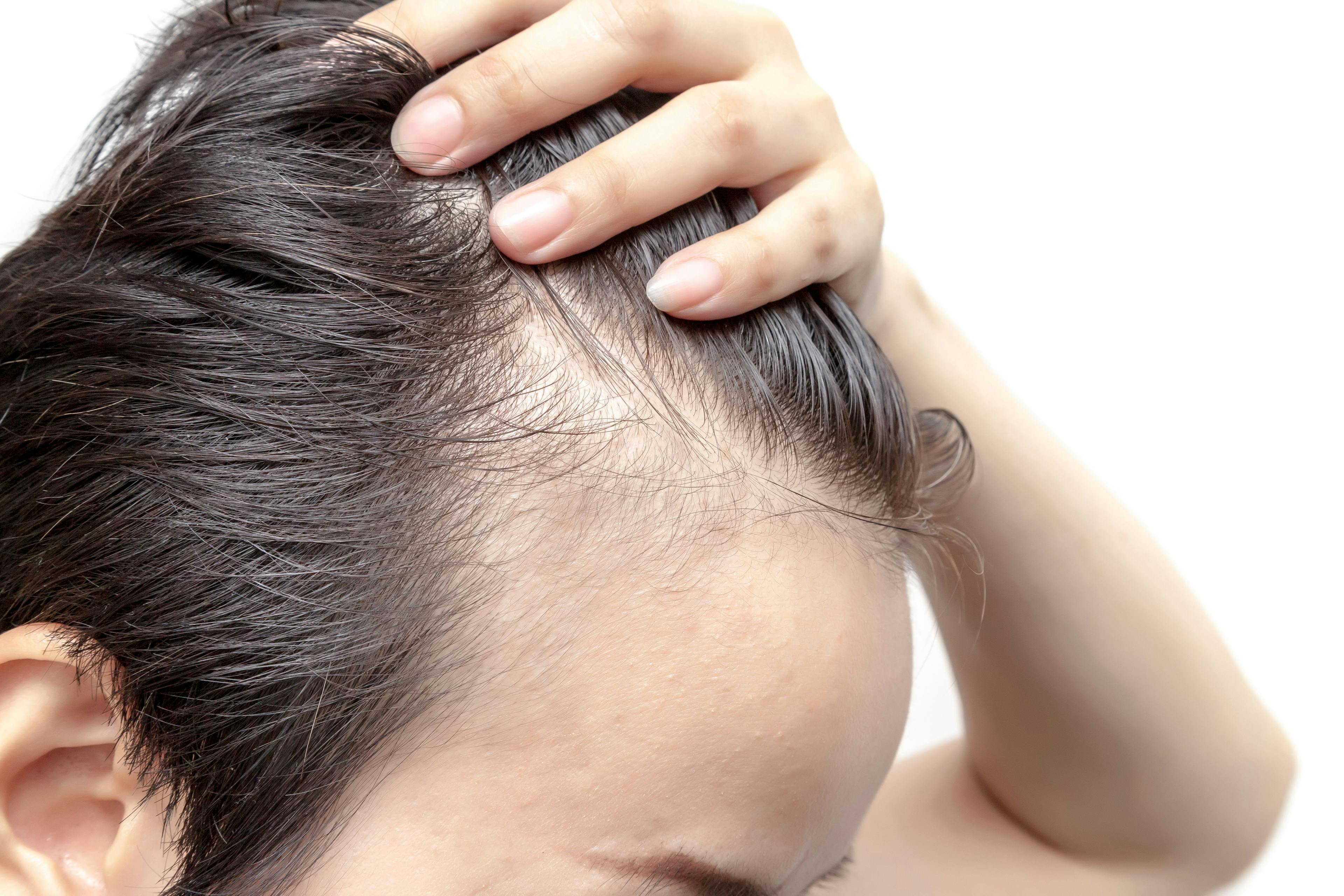 Combination of Two Drugs Effective In Treating Alopecia