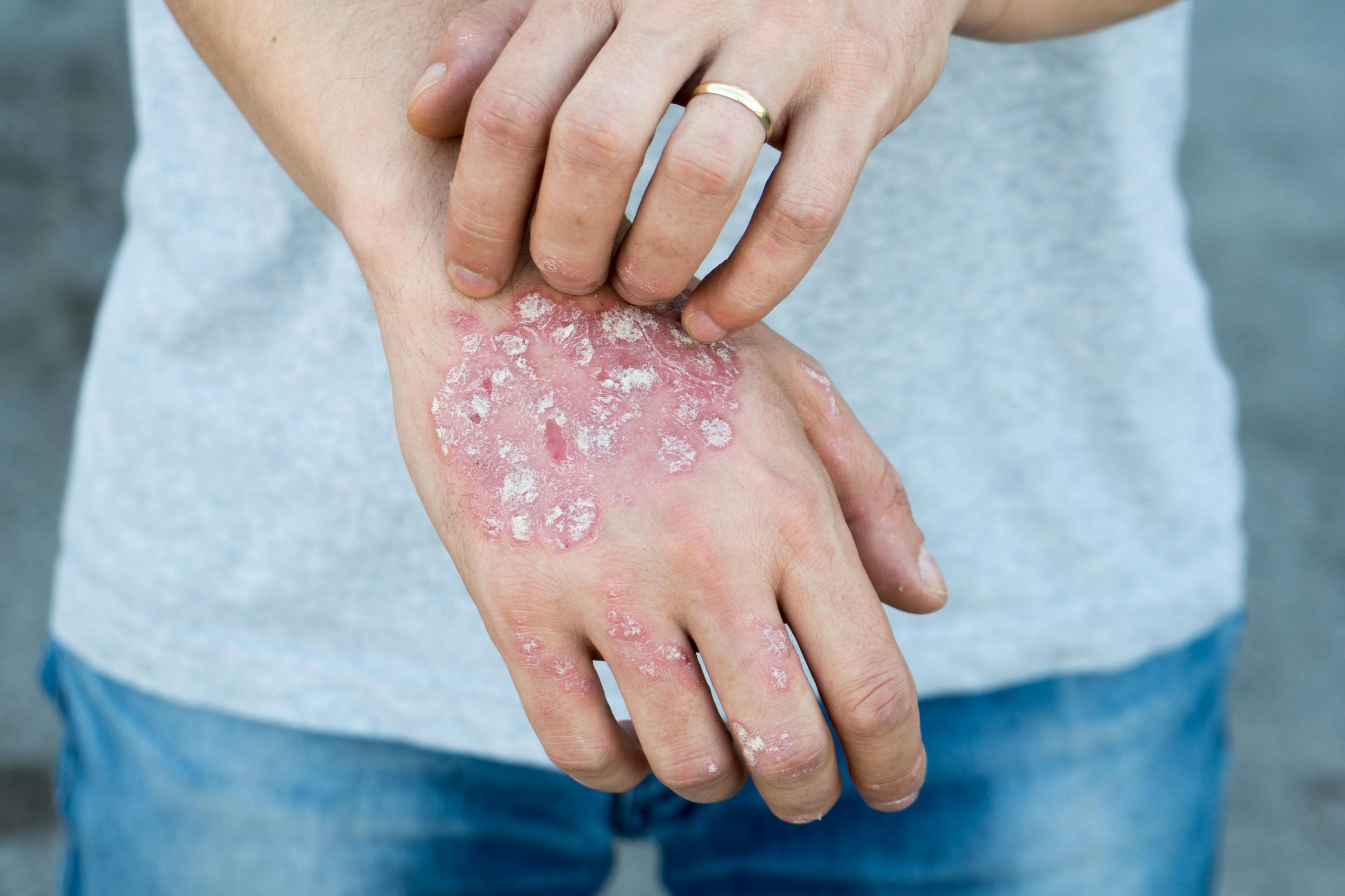 Plaque Psoriasis Nonsteroidal Treatment Options