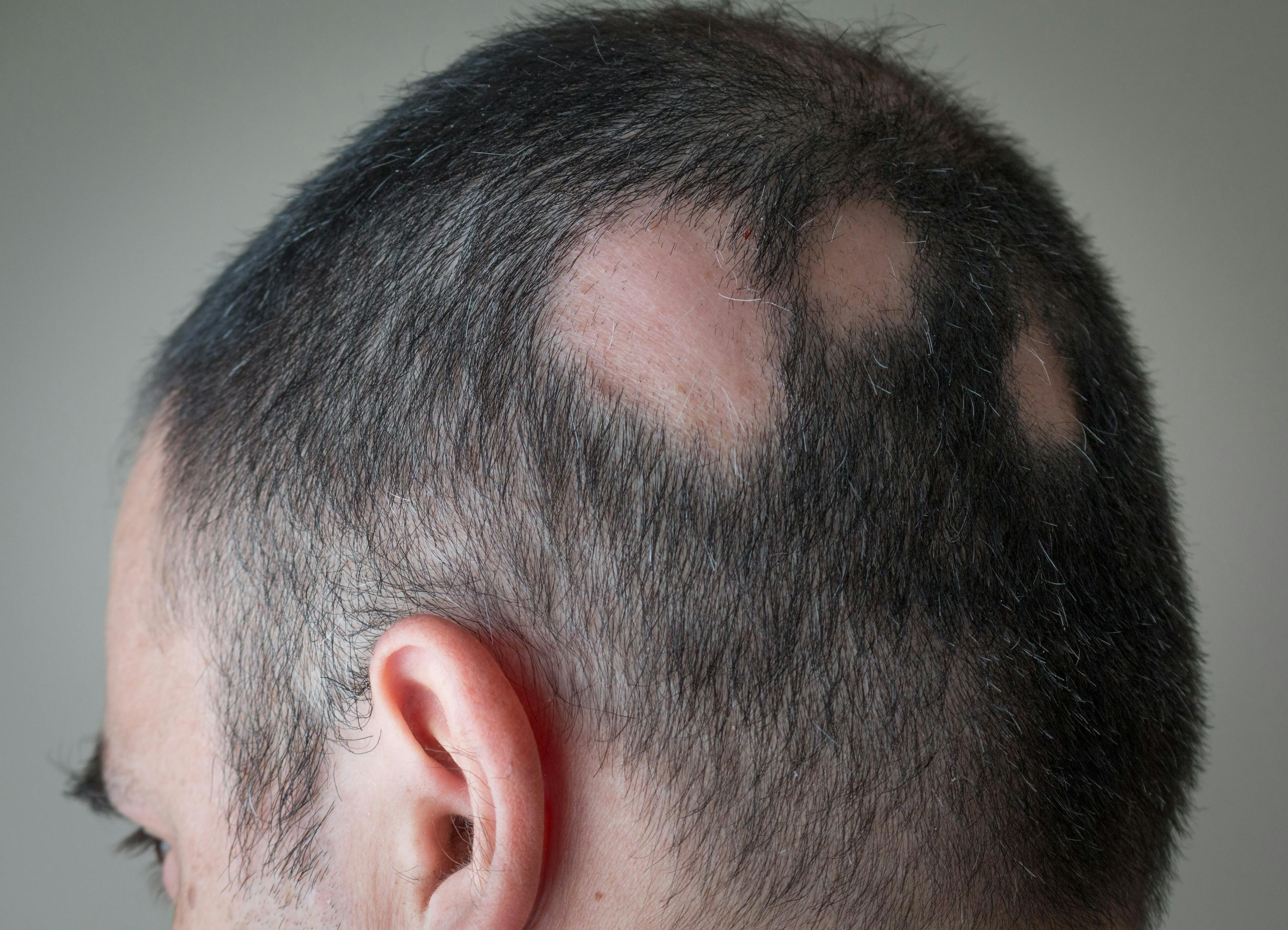 FDA Approves Ritlecitinib for Alopecia Areata for Adolescents, Adults