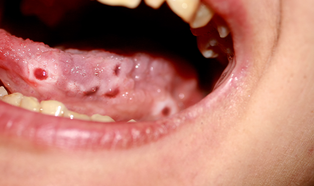 Ulcers on tongue