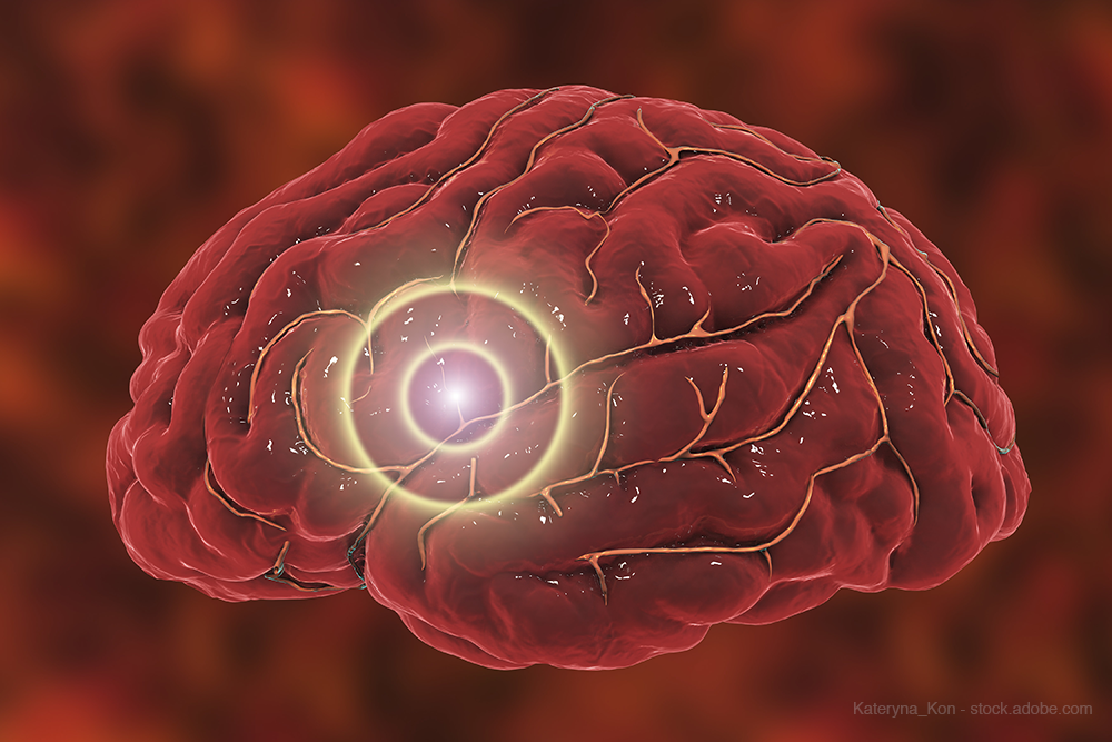 migraine sonar on brain