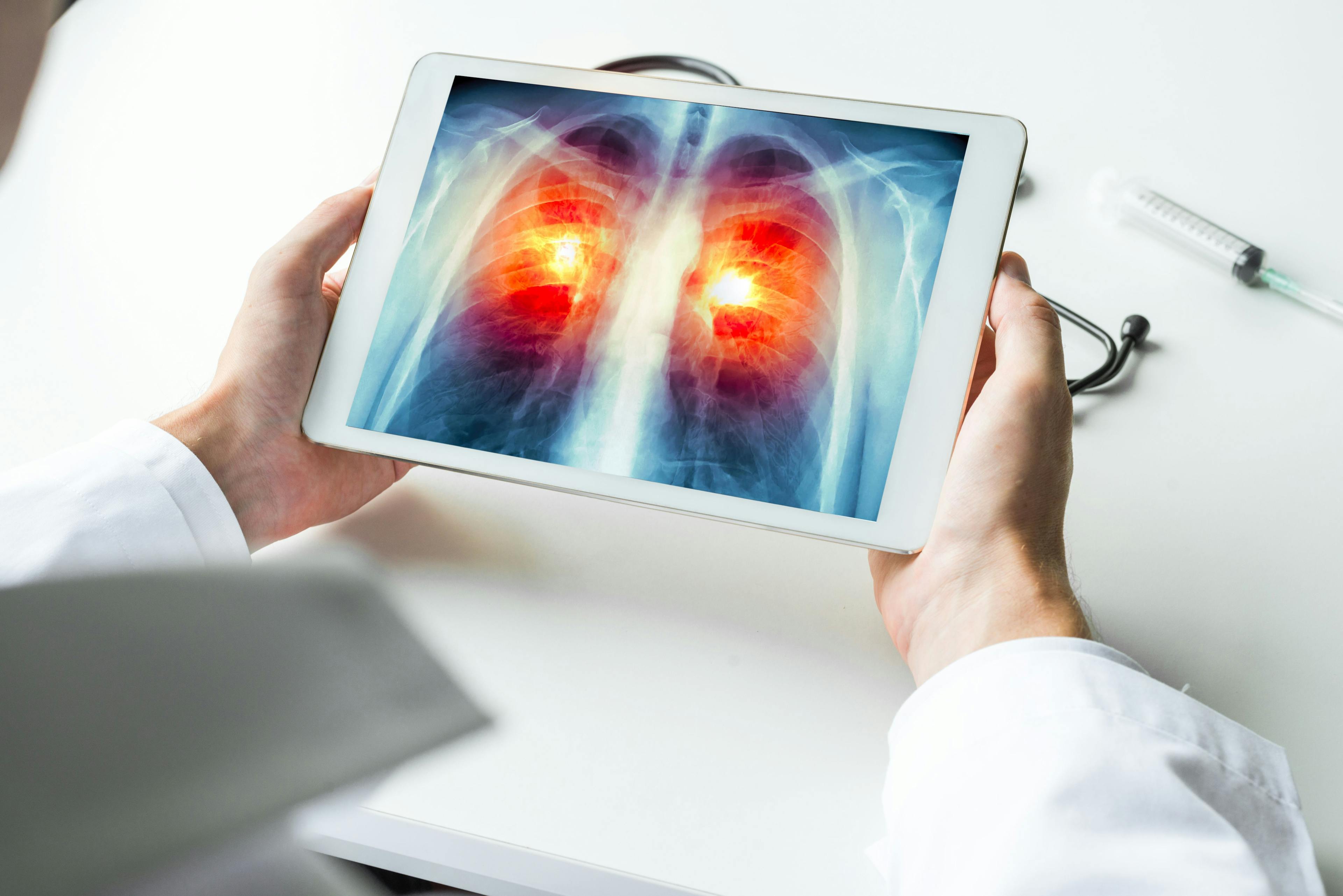 Race, Ethnicity Data in Screening Model Could Reduce Lung Cancer Screening Disparities