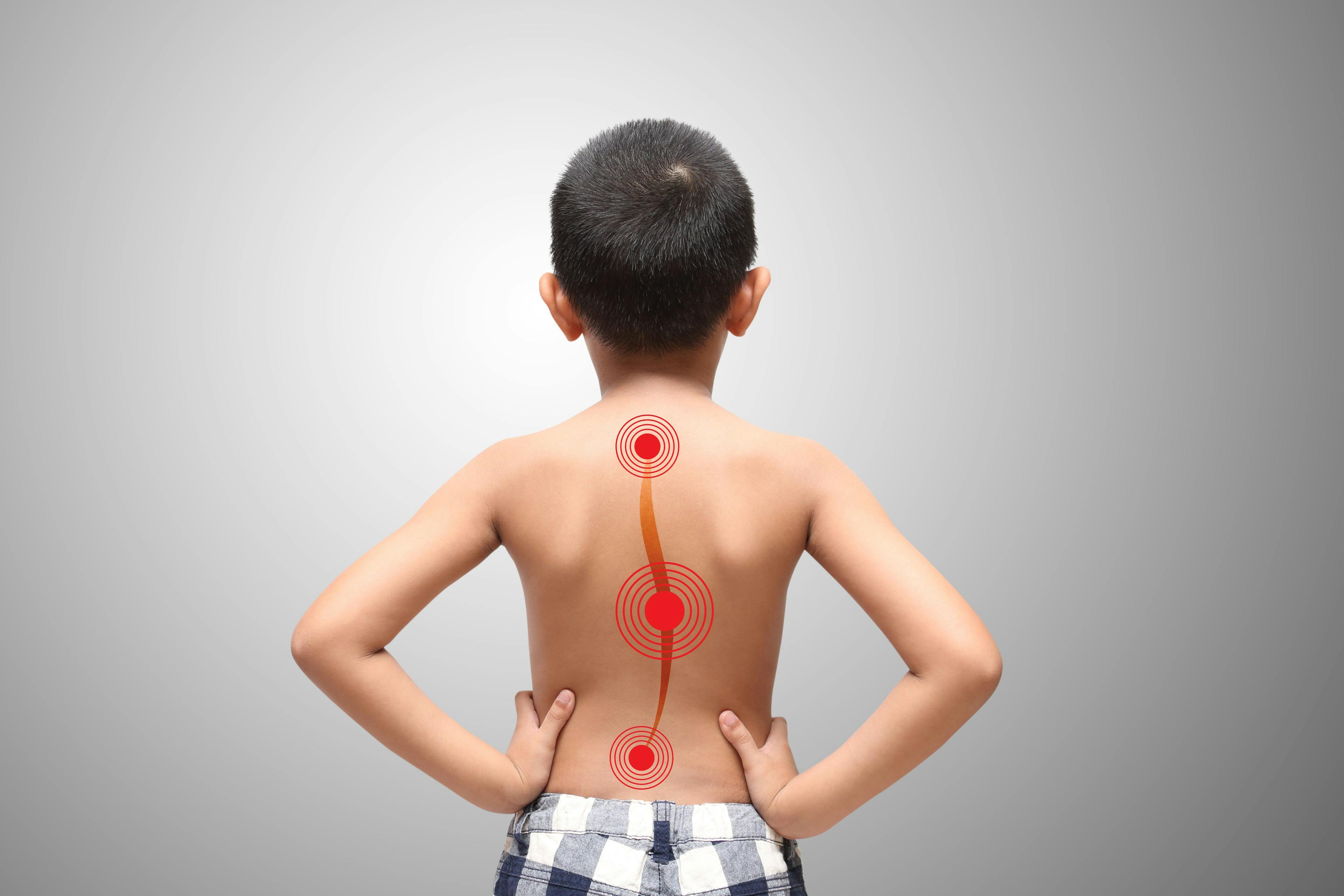 FDA Approves Scoliosis Treatment For Young Patients