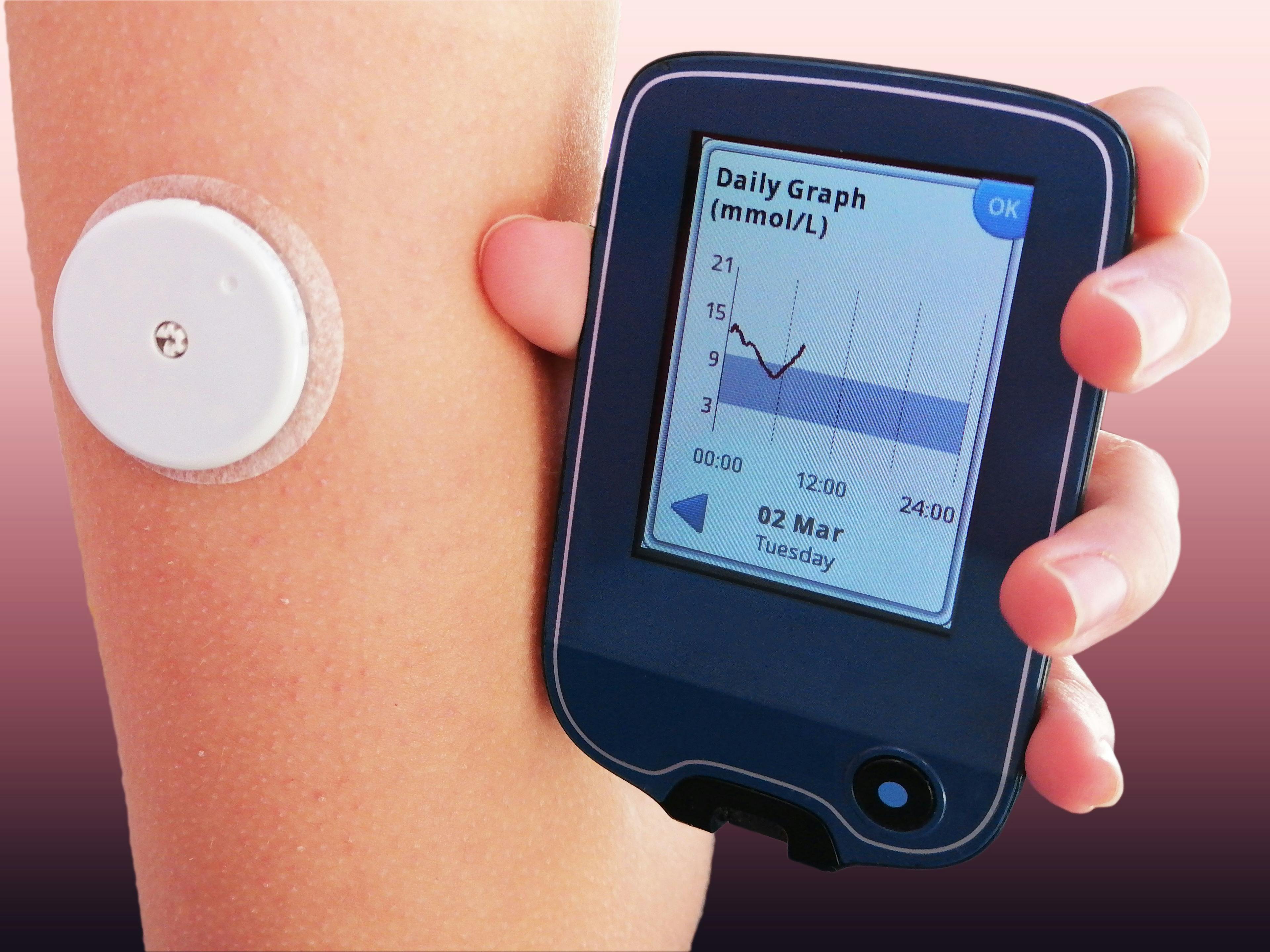 Continuous Glucose Monitors May Help Alleviate Care Burden for Parents of Young Children with T1D