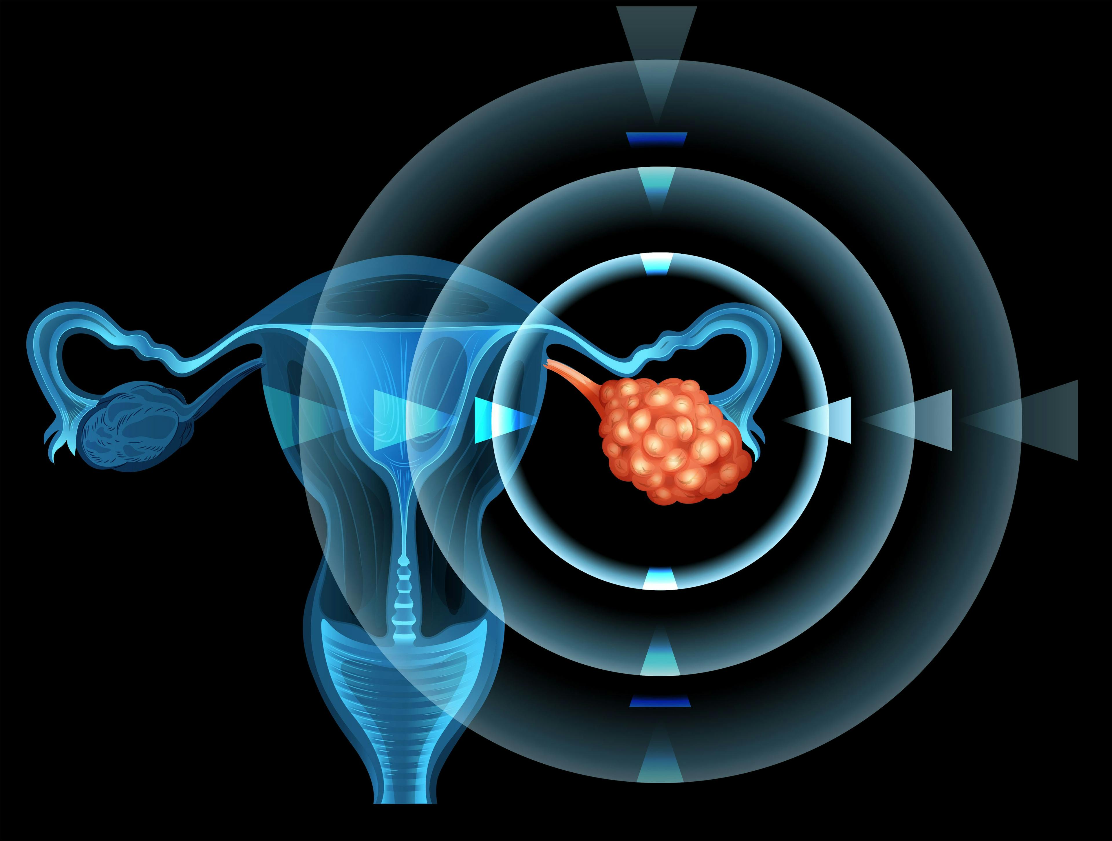 Fallopian Tube Removal Not Associated With Ovarian Cancer Risk