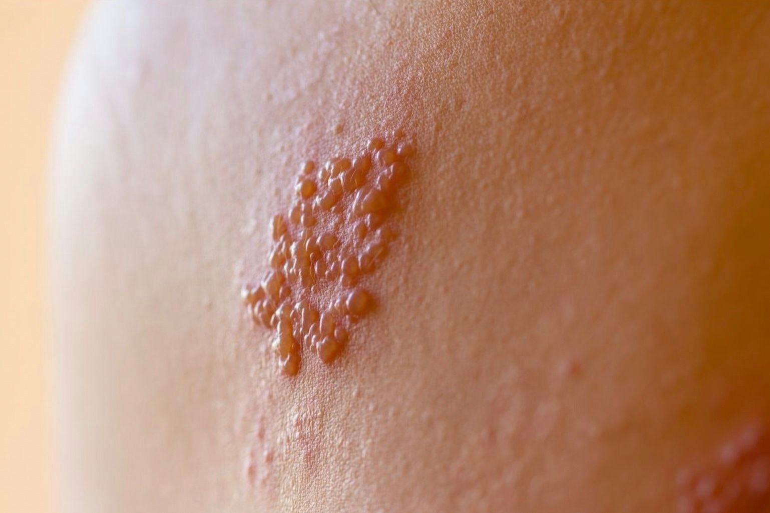 JAK Inhibitors May Increase Risk of Shingles in Patients With Immune-Mediated Inflammatory Diseases