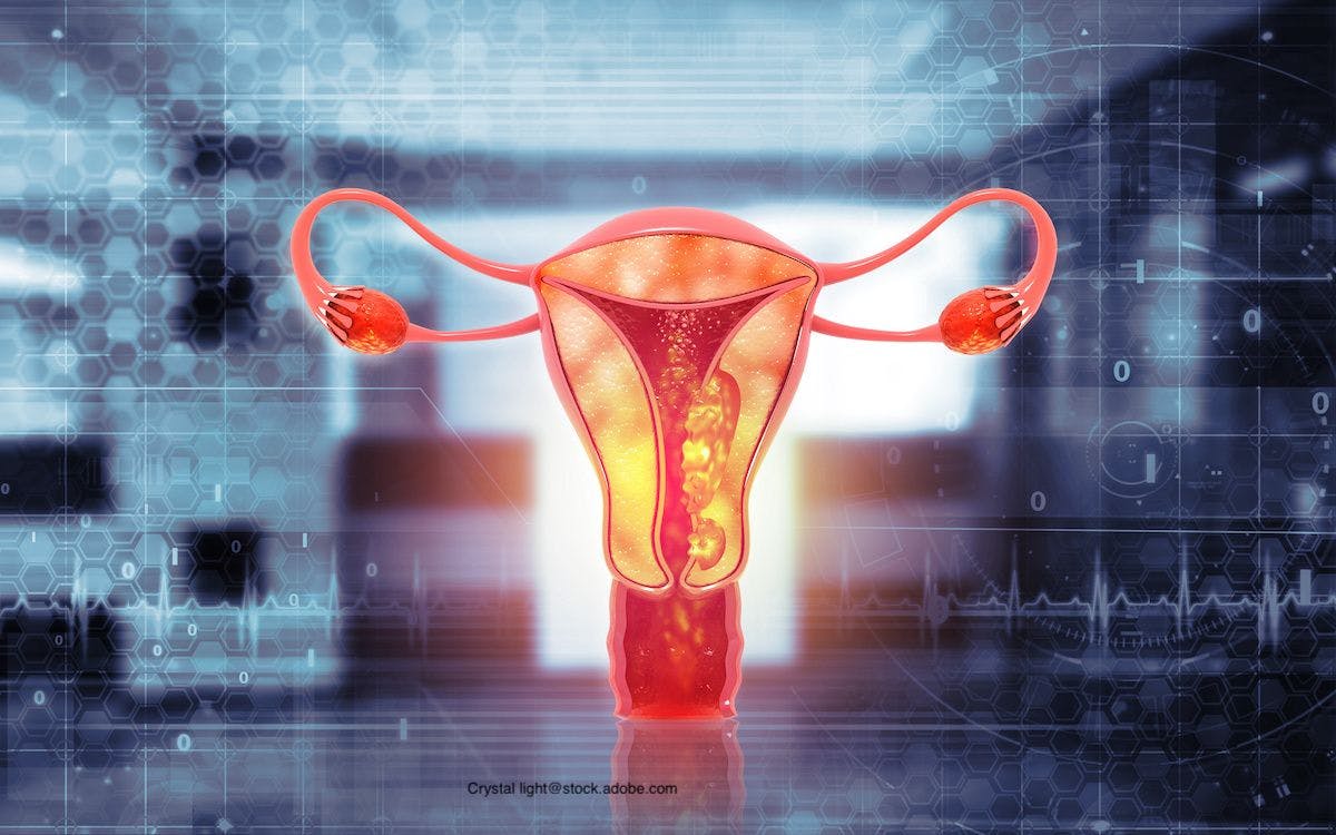 Positive Phase 3 Results for Jemperil Found for Endometrial Cancer Treatment