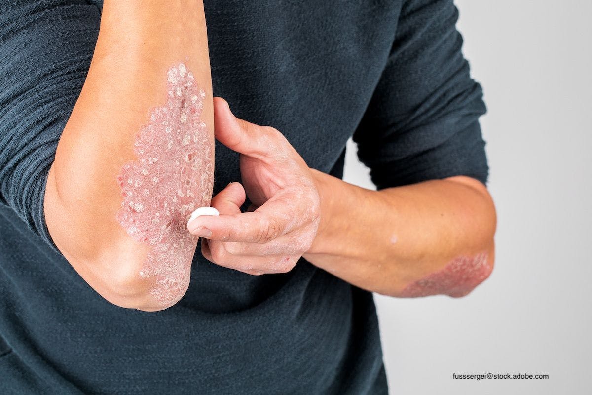 Psoriasis Can Be More Challenging in the Winter