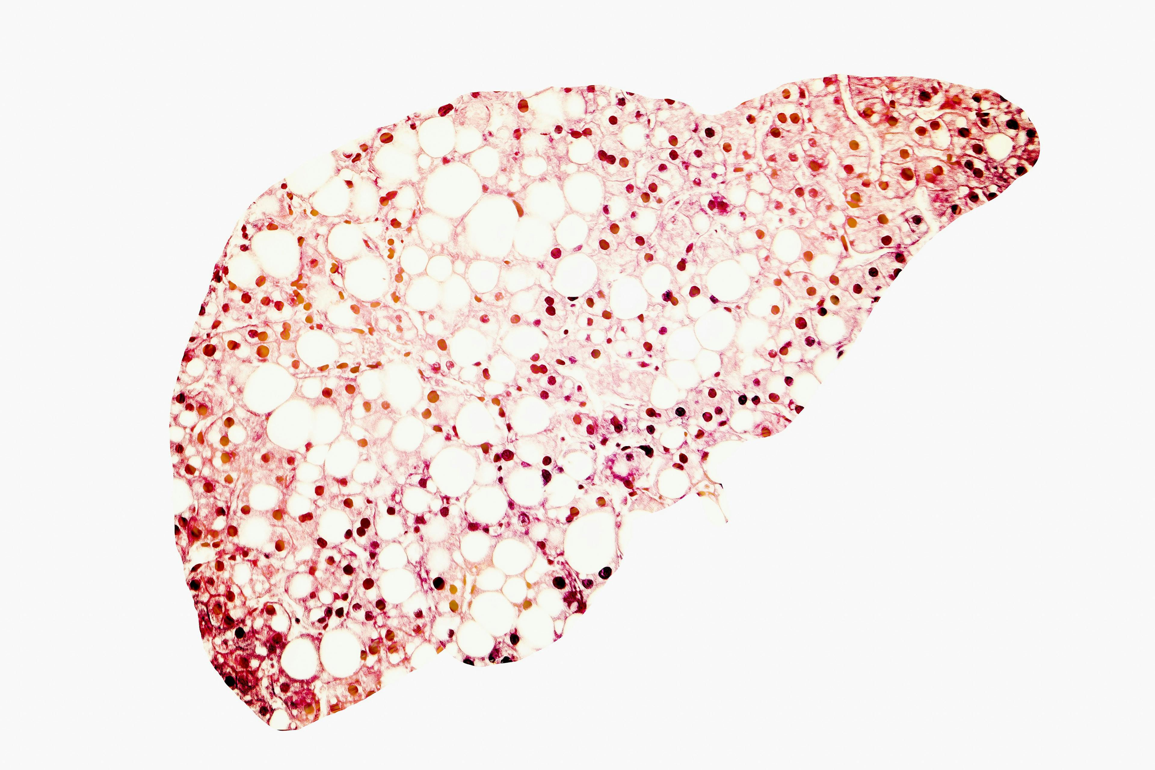Resmetirom Safe, Well-Tolerated in Non-Alcoholic Fatty Liver Disease