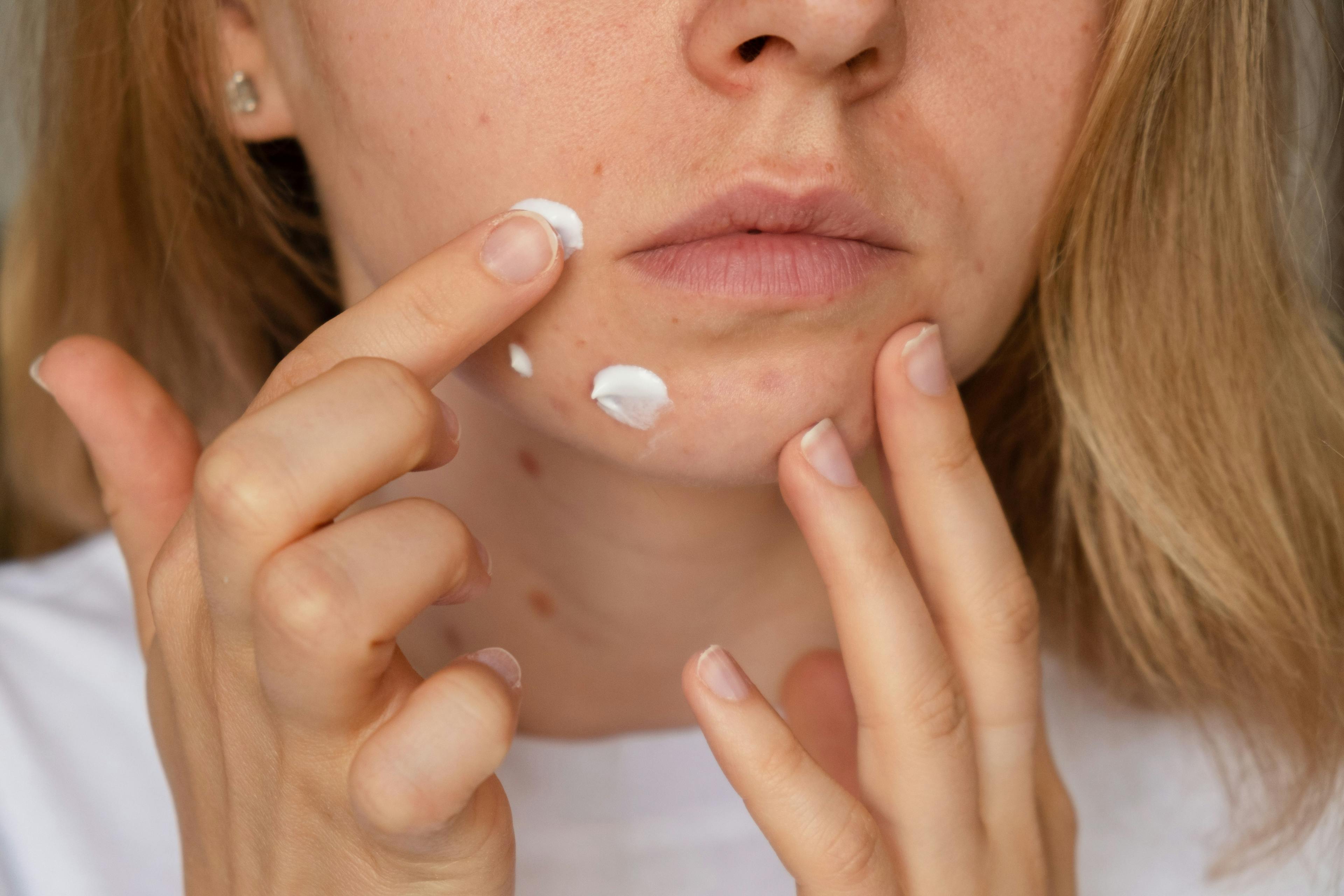 Woman using a product to treat acne / anna.stasiia - stock.adobe.com
