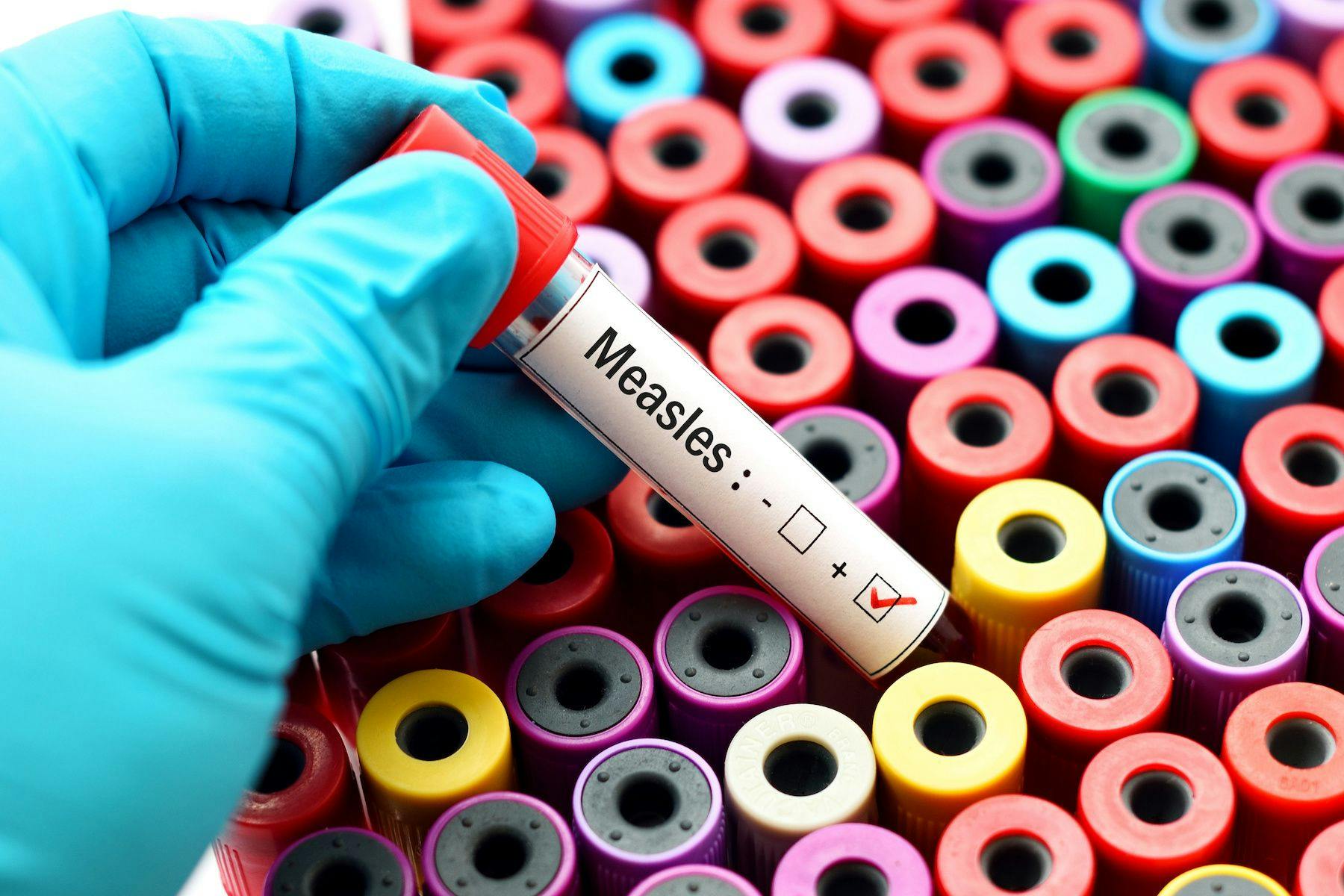blood sample of measles patient