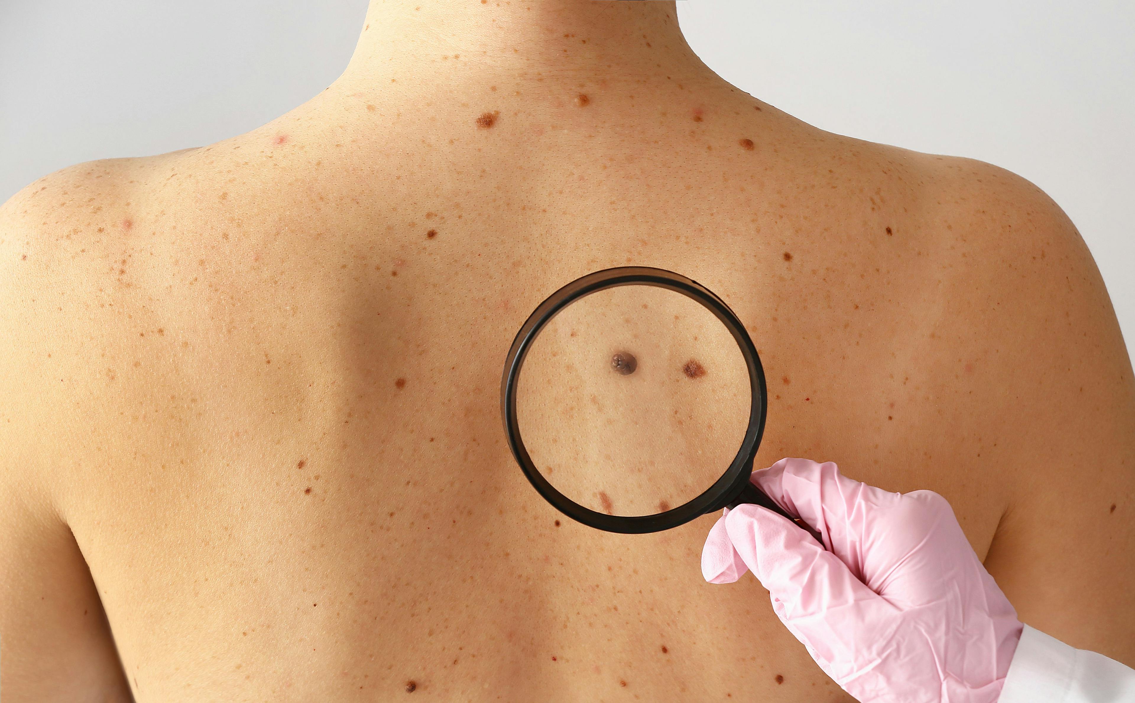 melanoma skin cancer | Image Credit: Pixel-Shot - stock.adobe.com