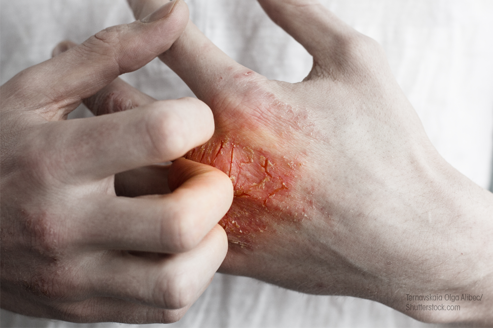 Eczema on hand