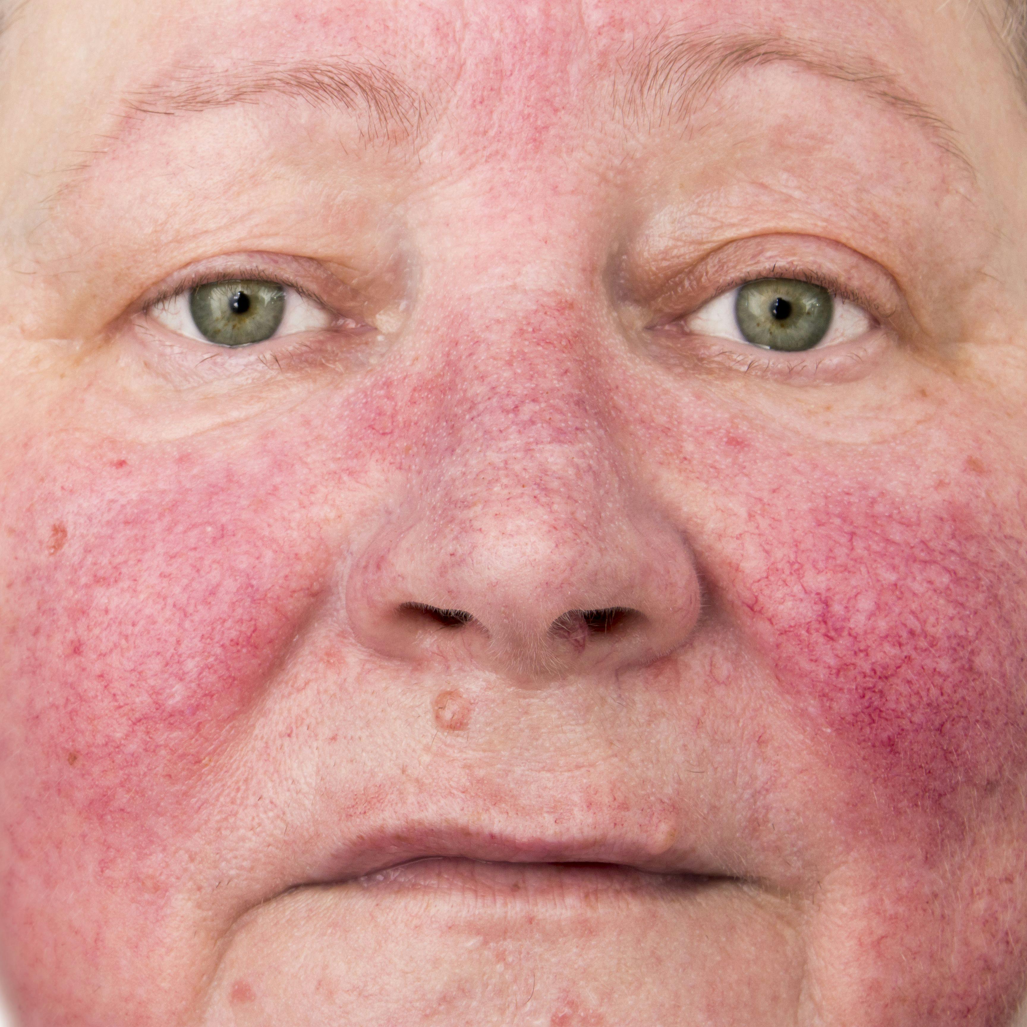 FDA Approves Epsolay for Inflammatory Lesions of Rosacea