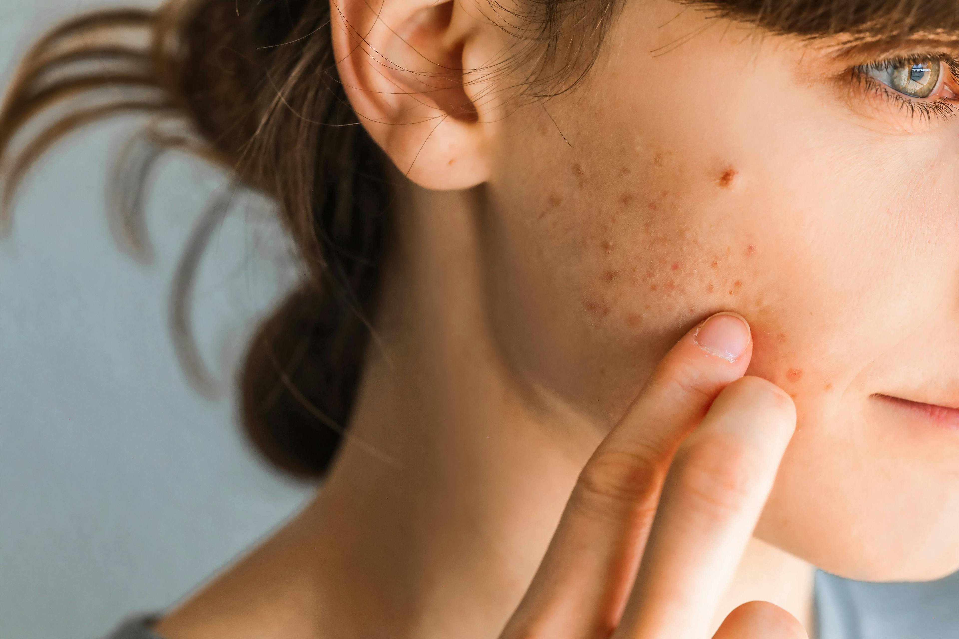 Acne Found to be Common Side Effect of Atopic Dermatitis Treatment