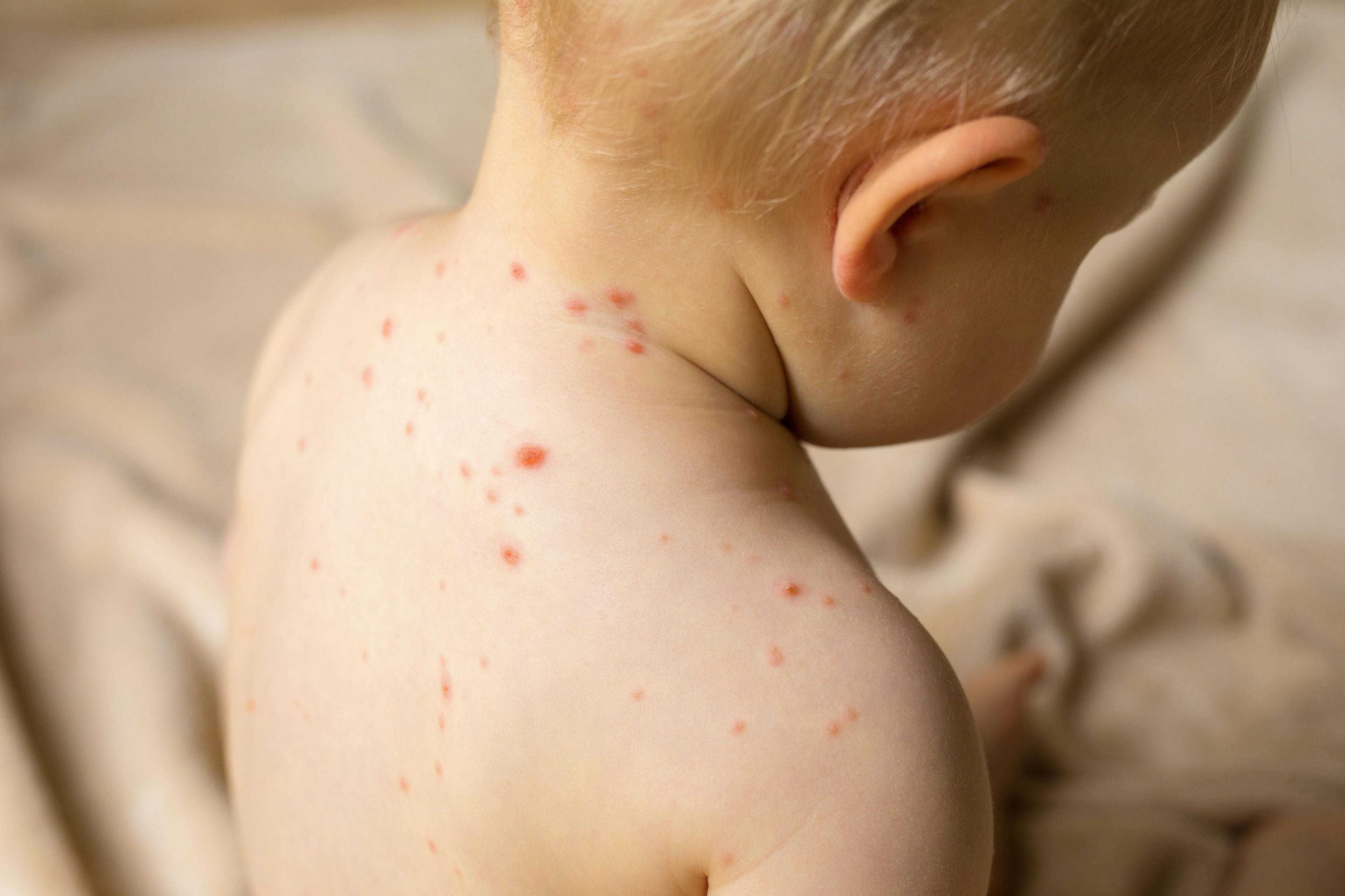 Routine Vaccination Makes Chickenpox Rare in United States
